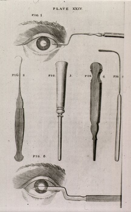 Kataraktchirurgie im Mittelalter